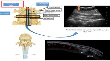 Ecografia Lumbar