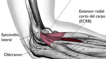 Epicondilitis Lateral