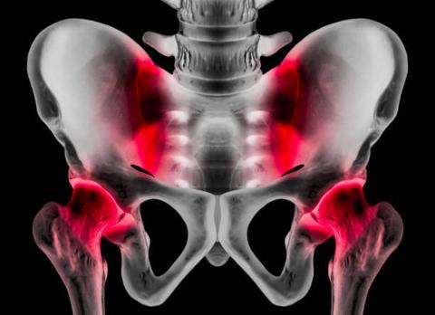 Osteopatia del Pubis