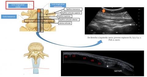 Ecografia Lumbar