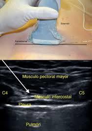 Ecografia Toracica