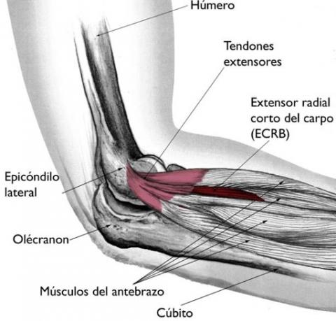 Epicondilitis Lateral